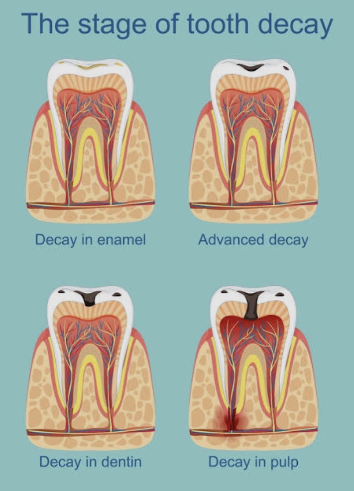 A medical diagram titled "The stage of tooth decay" showing four teeth in cross-section. It illustrates the progression of decay, from the first white spot in the Enamel, to "Advanced decay," then "Decay in dentin," and finally "Decay in pulp" with an active nerve infection.