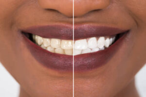 Close-up of smiling woman's teeth showing a before and after comparison of professional teeth whitening at Enamo Dental Clinic.