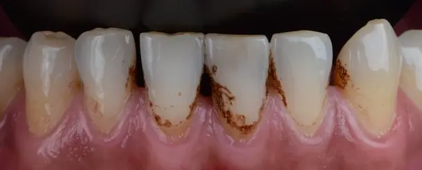 A medical close-up photograph of lower teeth and inflamed gums, showing prominent extrinsic stains: dark brown, granular tobacco deposits are accumulated heavily at the gumline and between the teeth.